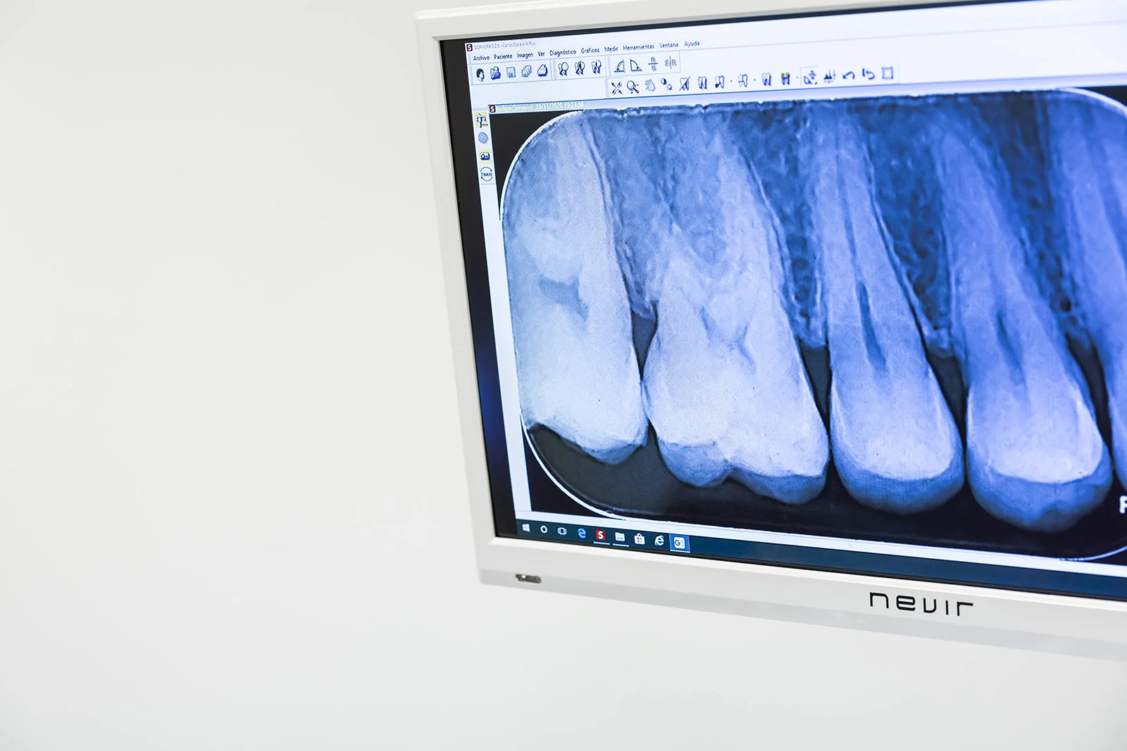 ENDODONCIA
